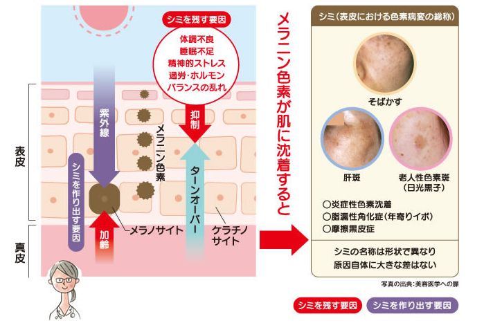 シミのしくみ